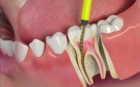 Root Canal Treatment :