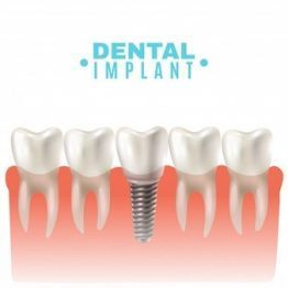Dental Implants: