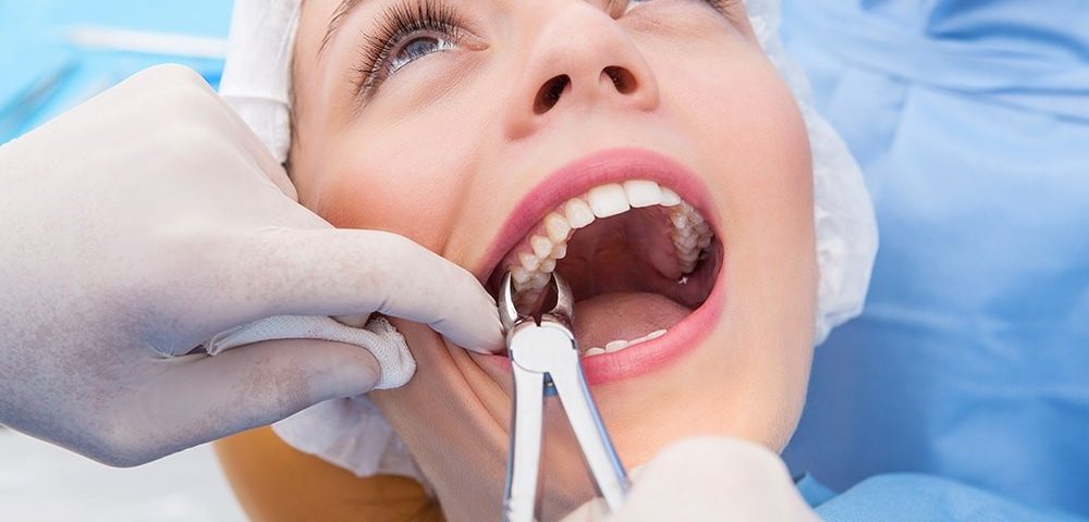 Tooth Extraction: