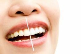 Tooth Whitening :