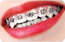 Orthodontic Treatment: